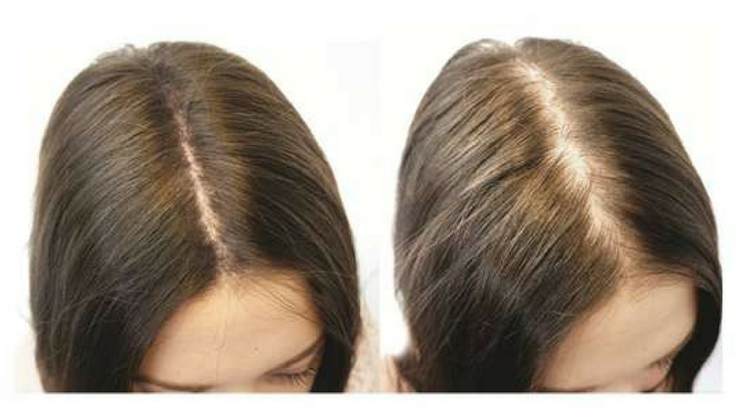 Hair Growth Oil – How Can You Naturally Grow Your Hair With The Best Hair Growth Oils Applied Daily