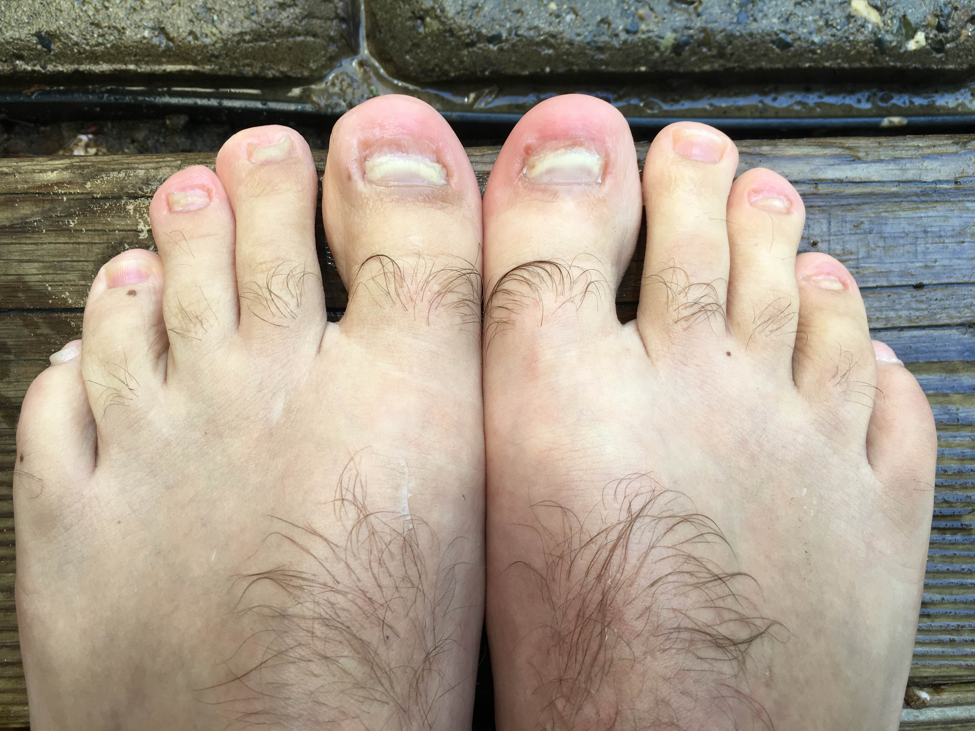 Invasion Of The Toenail Fungus