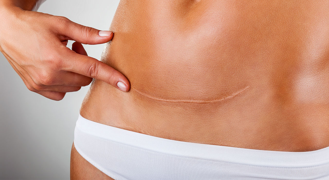 Feel Great This Year With The Best Tummy Tuck Treatment