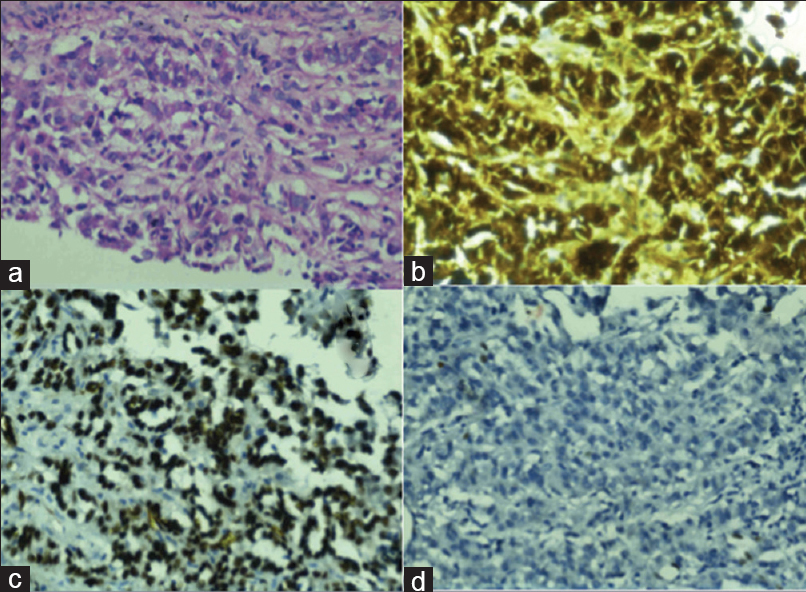 What Are The Most Common Indicators Of A Epithelial Mesothelioma Metastasis?